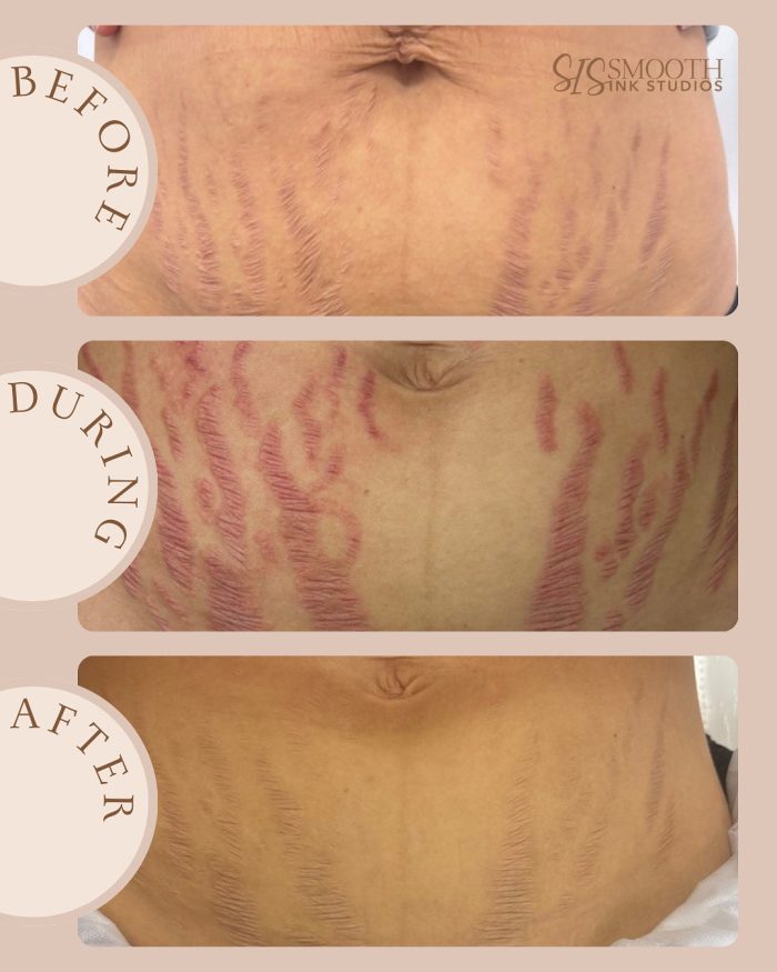 Treatment-ISR Neutral Before and After