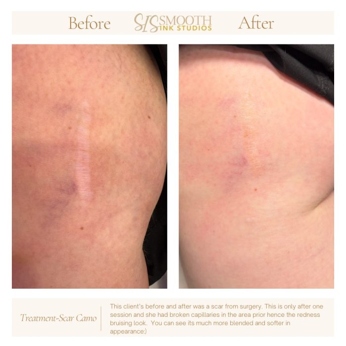 Treatment-Scar Camo Neutral Before and After