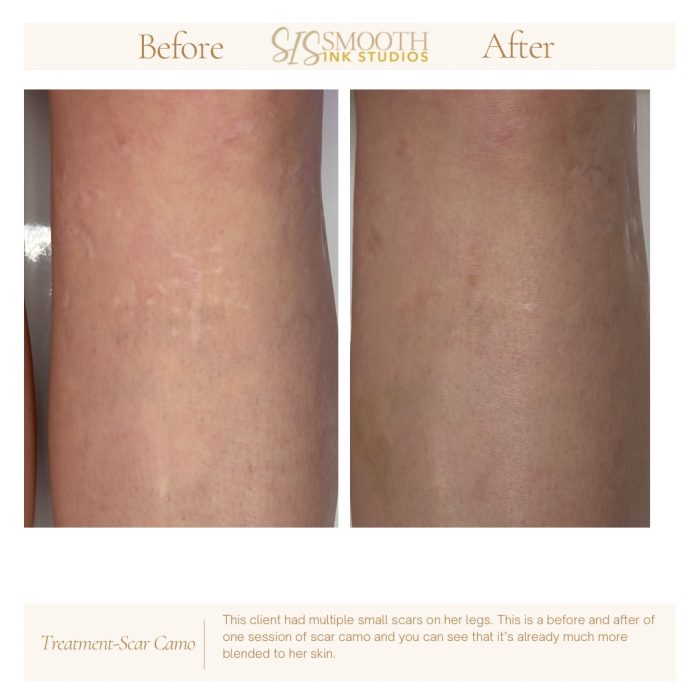 Treatment-Scar Camo Neutral Before and After