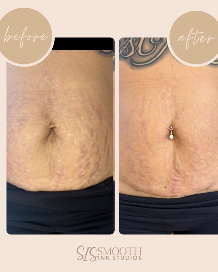 Treatment-ISR Before and After